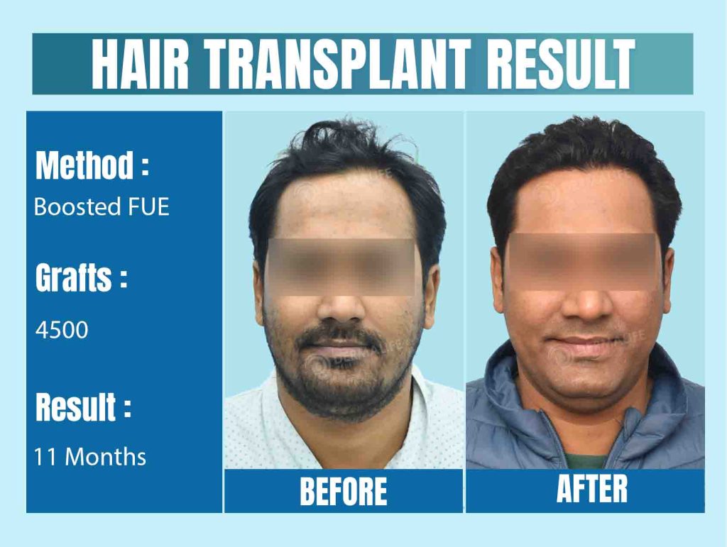 Touching Hair Grafts Following Transplant: How Soon Is Okay?